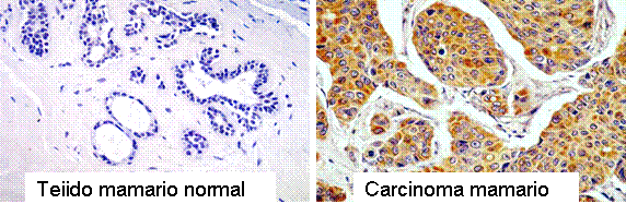 Inmunohistoquímica mostrando detección de hemoxigenasa-1 en el carcinoma mamario 